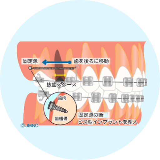 矯正期間を短くしたいのであれば